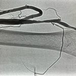 Angioplasty