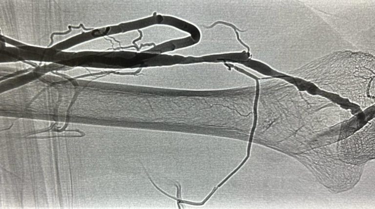 Angioplasty