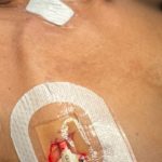 Permanent Tunnelled Dialysis Catheter