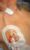 Permanent Tunnelled Dialysis Catheter