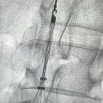 IVC Filter
