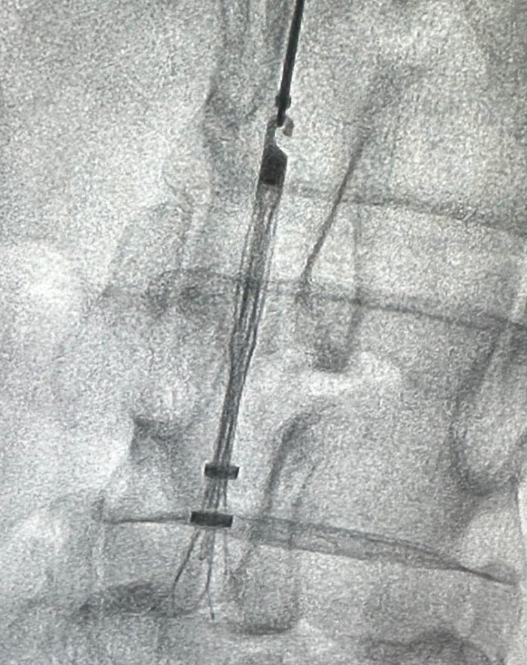 IVC Filter