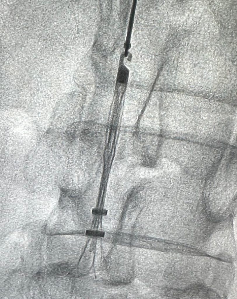 IVC Filter