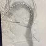 Aortic Dissection