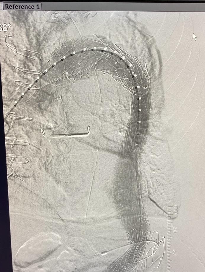 Aortic Dissection