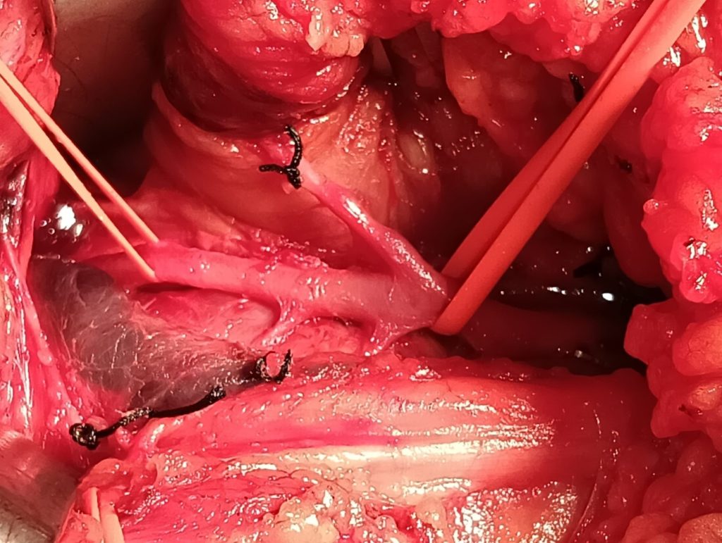 chronic compartment syndrome