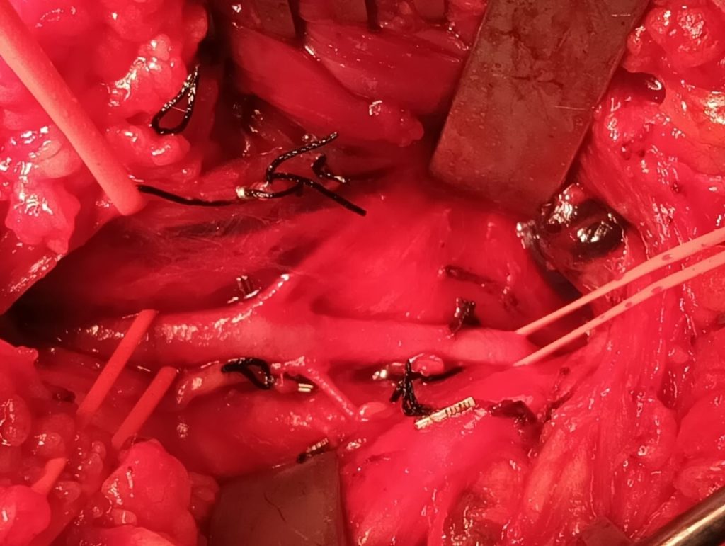 chronic compartment syndrome2