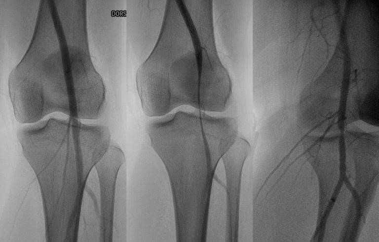 Popliteal entrapment syndrome