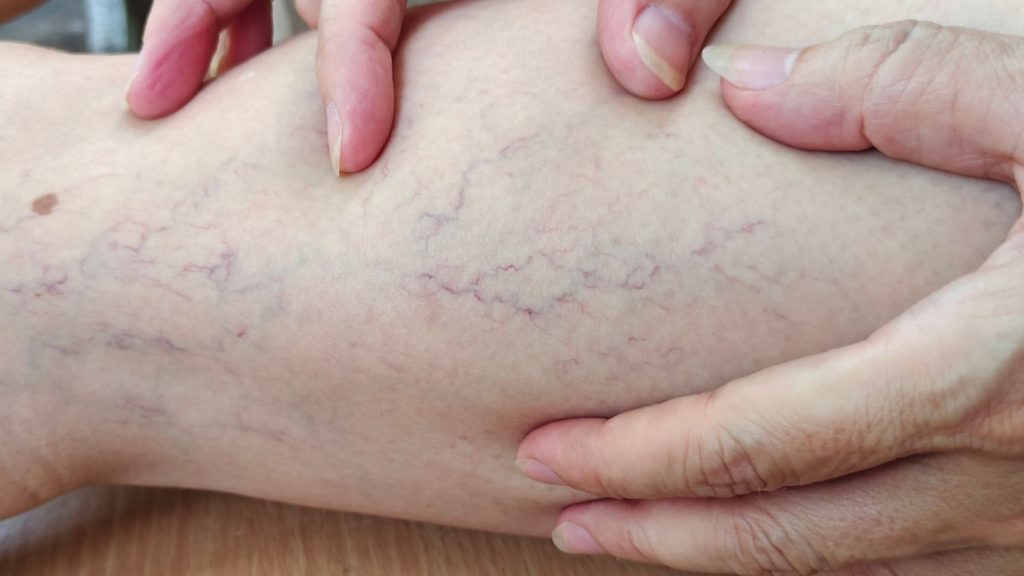 Comprehensive Guide to Microwave Ablation