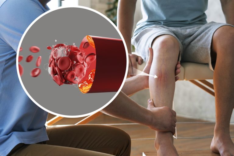 Do Varicose Veins Recur - Cover image