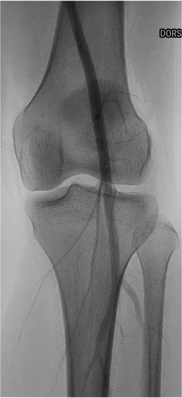 Treatment chronic compartment
