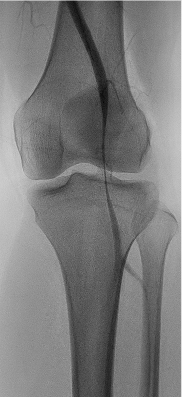 Treatment chronic compartment2