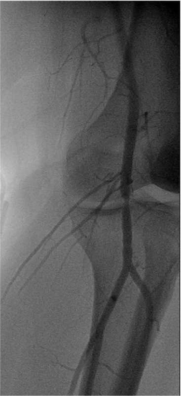 Treatment chronic compartment3