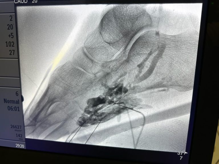 Venous Malformation