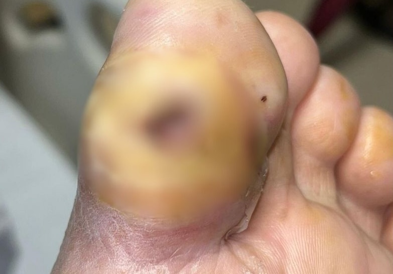 Diabetic Foot Ulcer