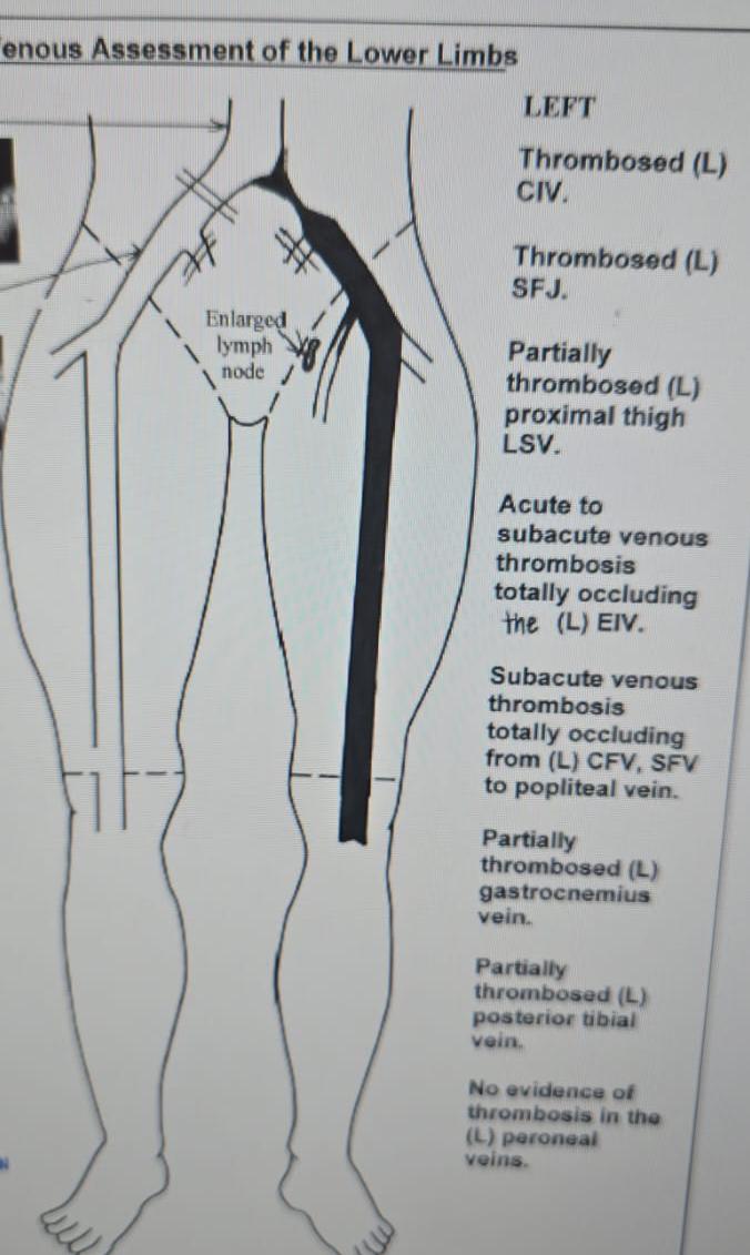 Treat a Deep Vein Thrombosis Surgically