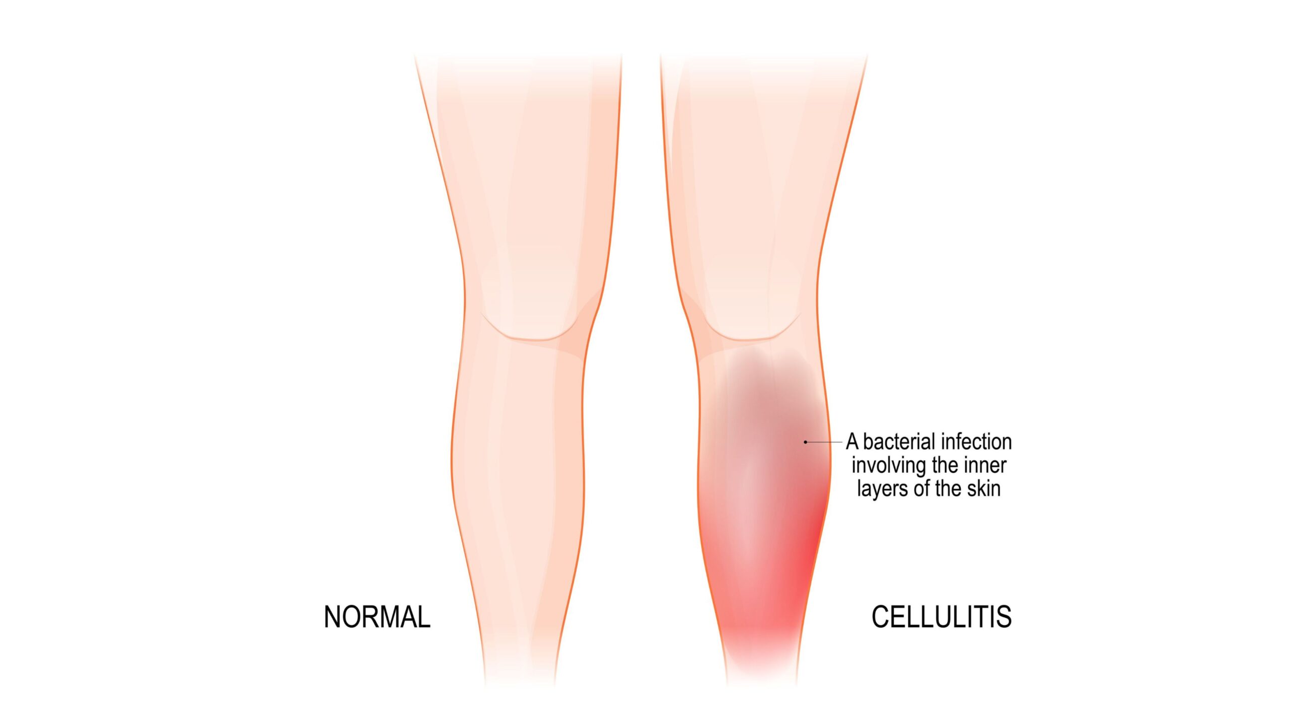 Illustration comparing a normal leg and a leg affected by cellulitis, showing redness on the infected lower calf.