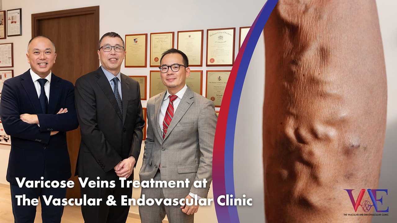 Varicose Vein Treatment in Singapore: A Comprehensive Guide