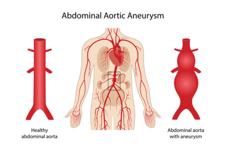 Living With an Aortic Aneurysm: Exercise, Travel and Monitoring - The ...